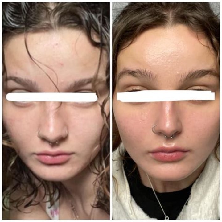 Accutane Nose Job: What You Need to Know Before Considering Surgery